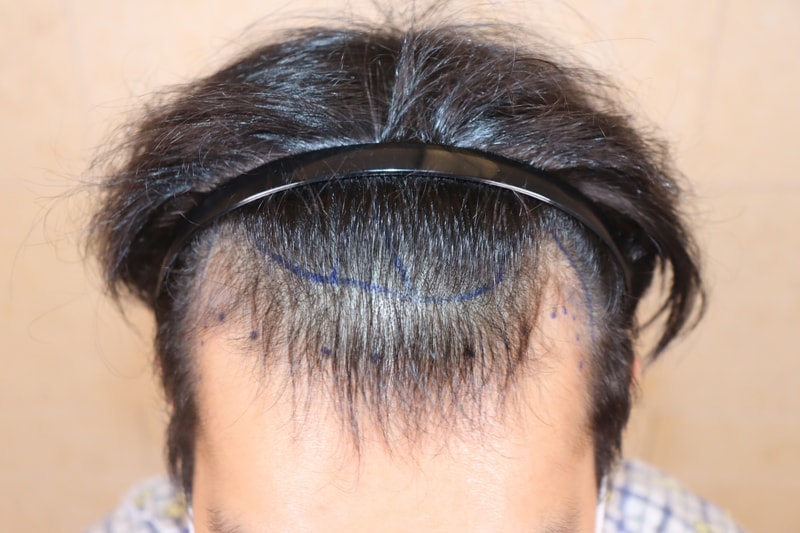 움찬 모발이식 8개월차 경과입니다...!