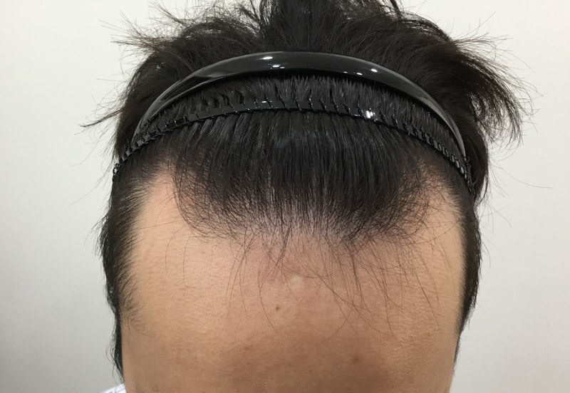 4th Month of Hair Transplantation Review