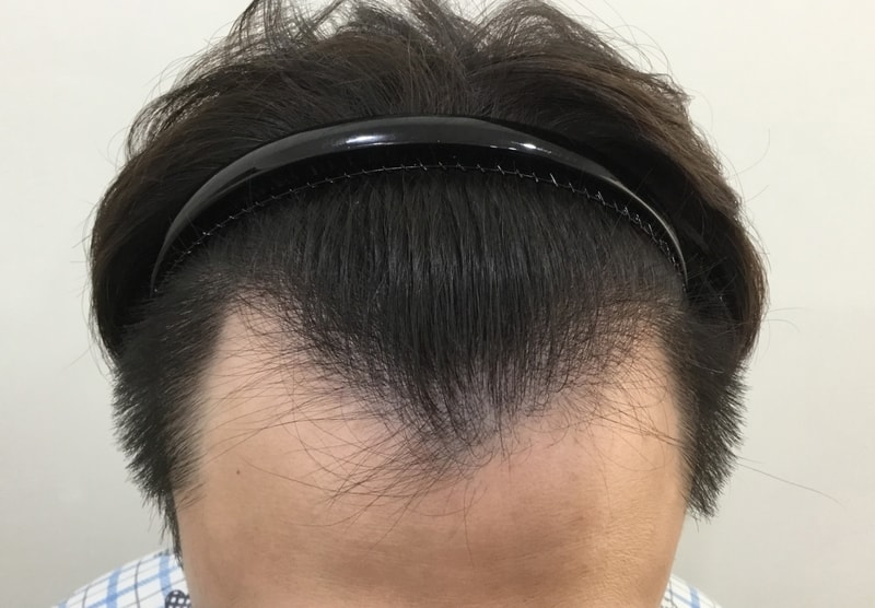 비절개 3일차 후기