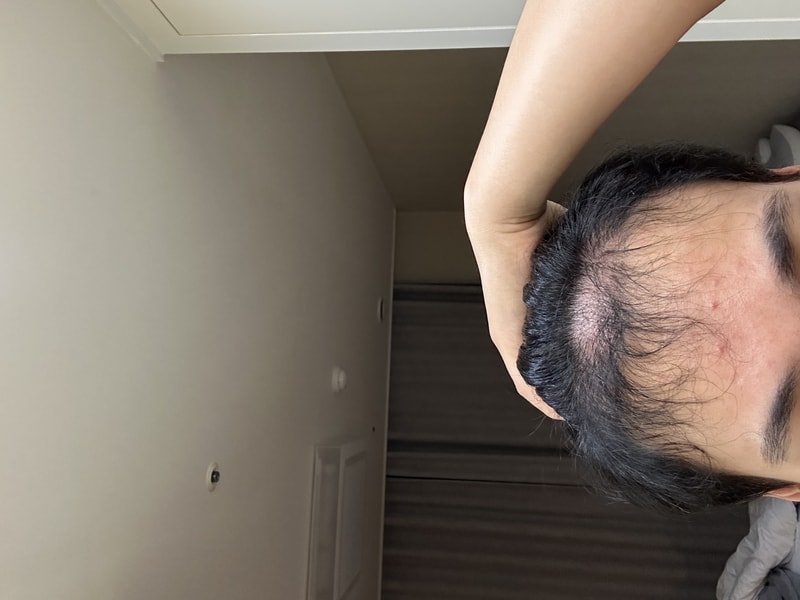 뉴헤어 모발이식 4000모낭 6개월 후기