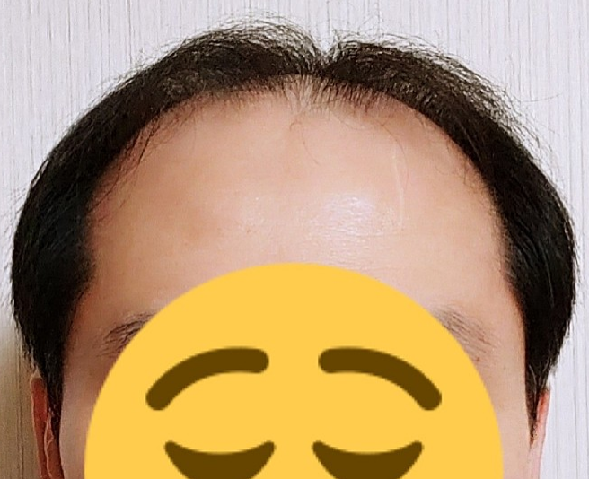 비포.PNG