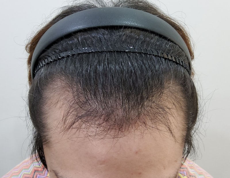 移植第3个月后期