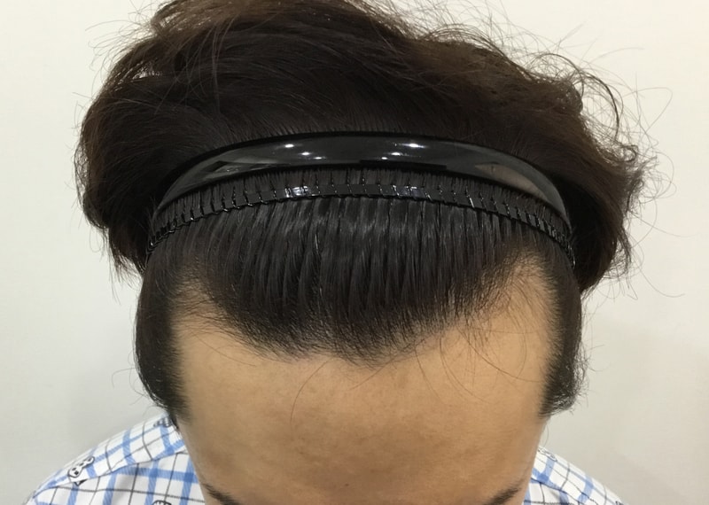 어제 이식받았습니다