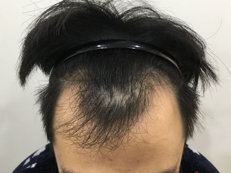4th day of hair transplantation review