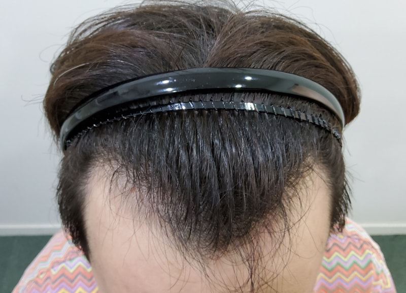 移植2週目の感想をお送りします