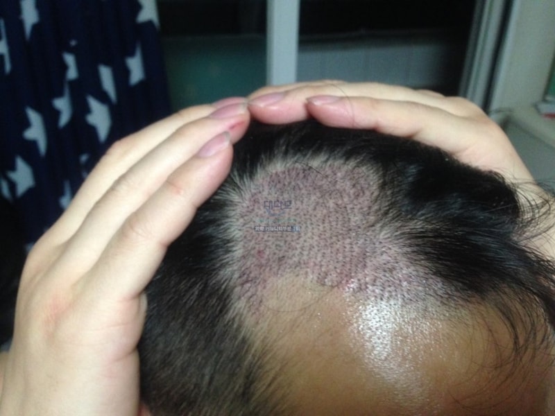 It's 124 days after the surgery.