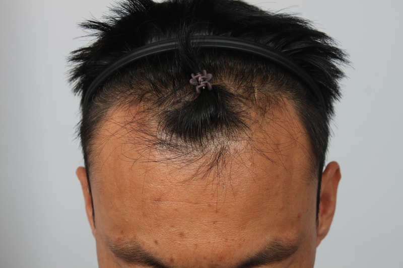 수술전.JPG