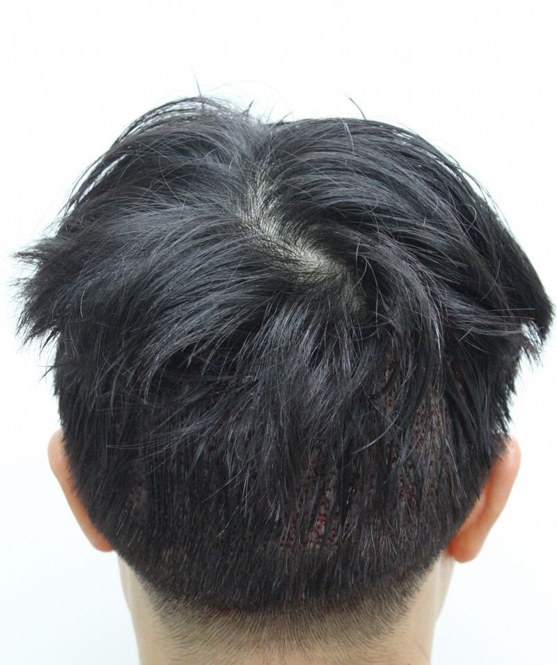 수술직후.jpg