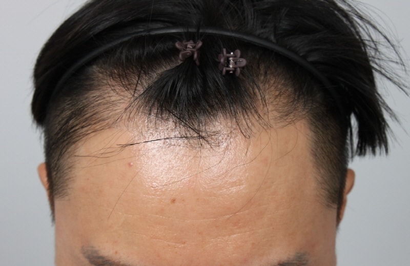 フォーヘア釜山店 毛髪移植 1ヶ月目