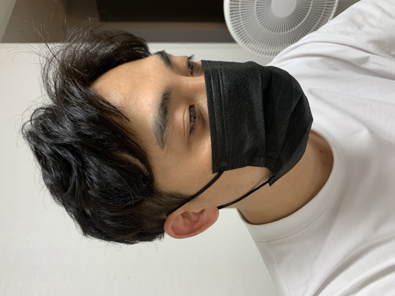 What I felt after a year and a half hair transplant