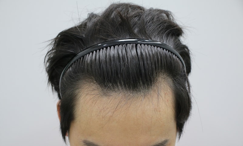 수술전.jpg