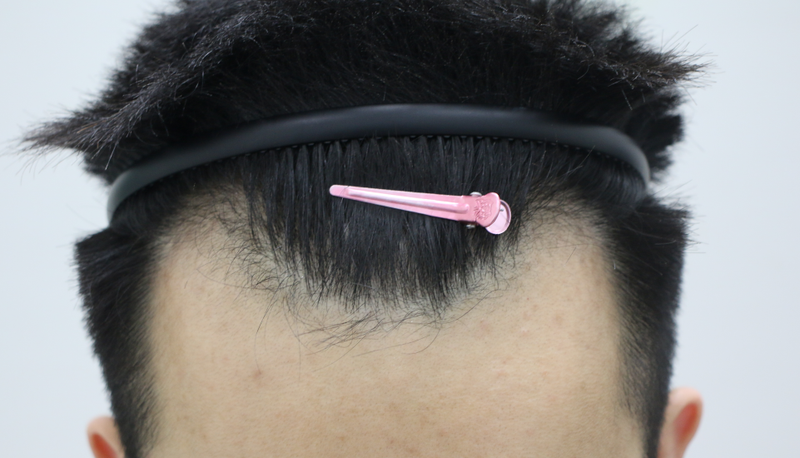 FOHAIR毛发移植第11个月后期