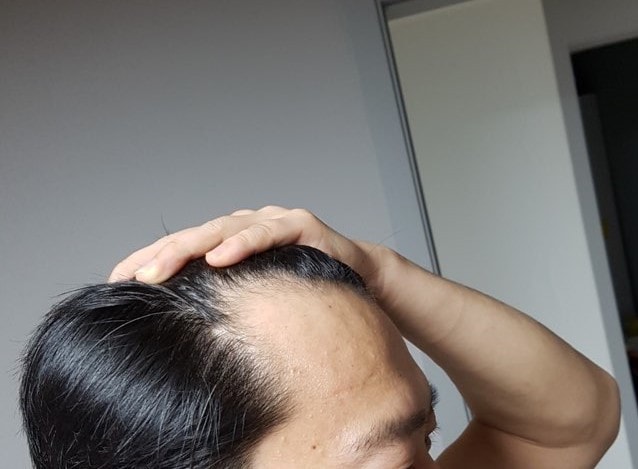 수술전 오른쪽.jpg