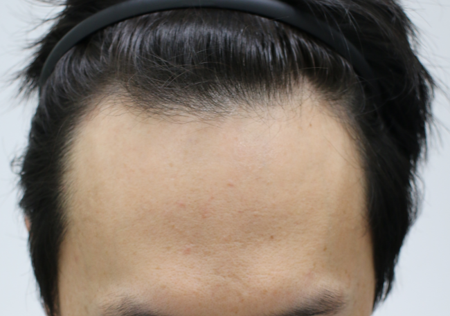 Four months of forehair non-excision, the best thing I've ever done in my life with a hair transplant