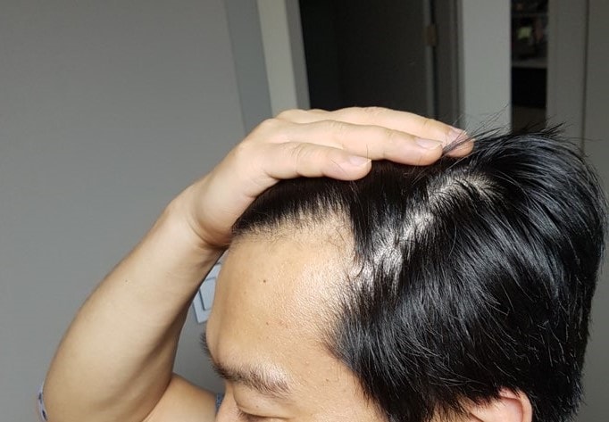 수술전 왼쪽.jpg