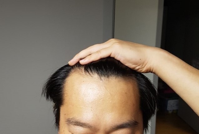 수술전 정면.jpg