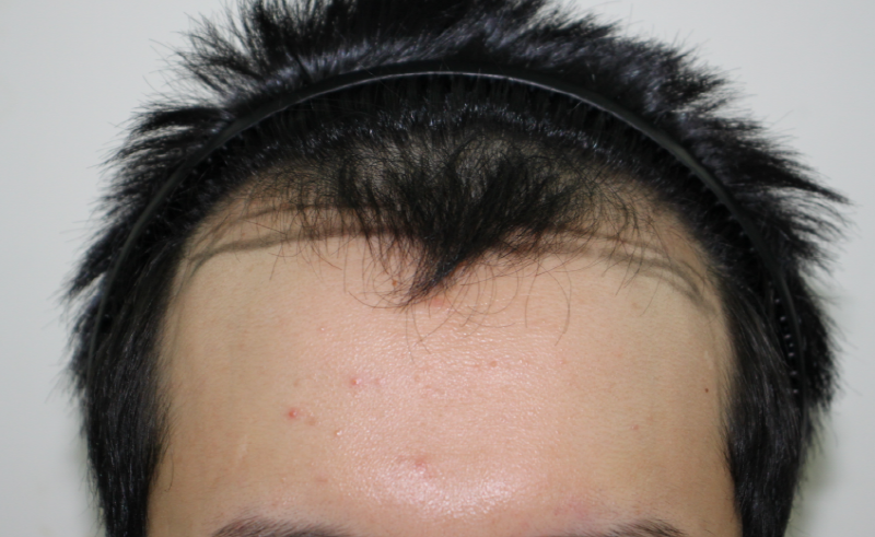 [Four Hair] Daegu Four Hair M-shaped Hair Transplantation 1 Year Review