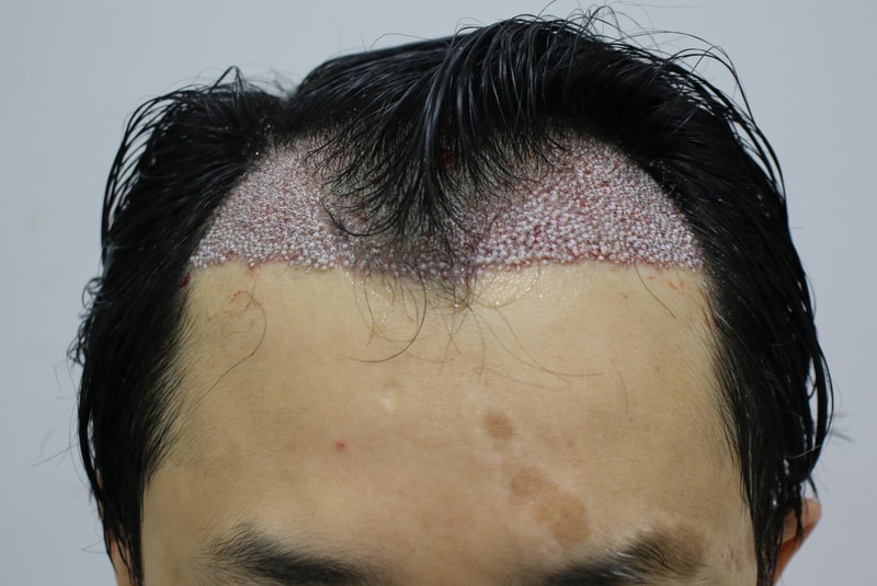 수술후.jpg