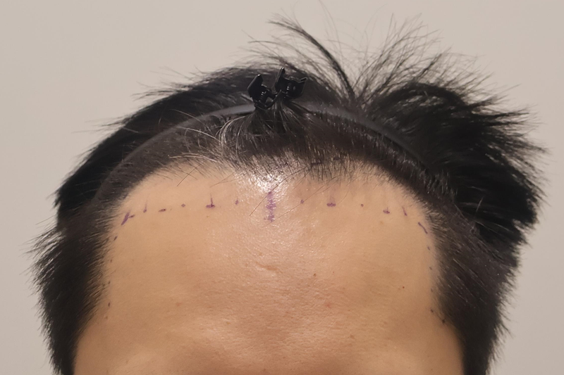 Immediately after the transplantation of 2,800 hairs at Incheon Maimo Medical Center