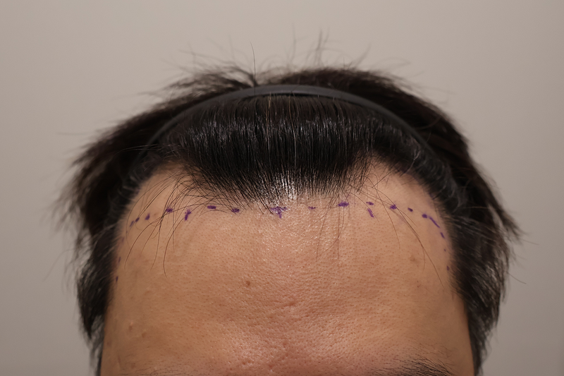 Incheon Maimo Medical Center 1200 Hair follicle partial cut-off 2 weeks have passed