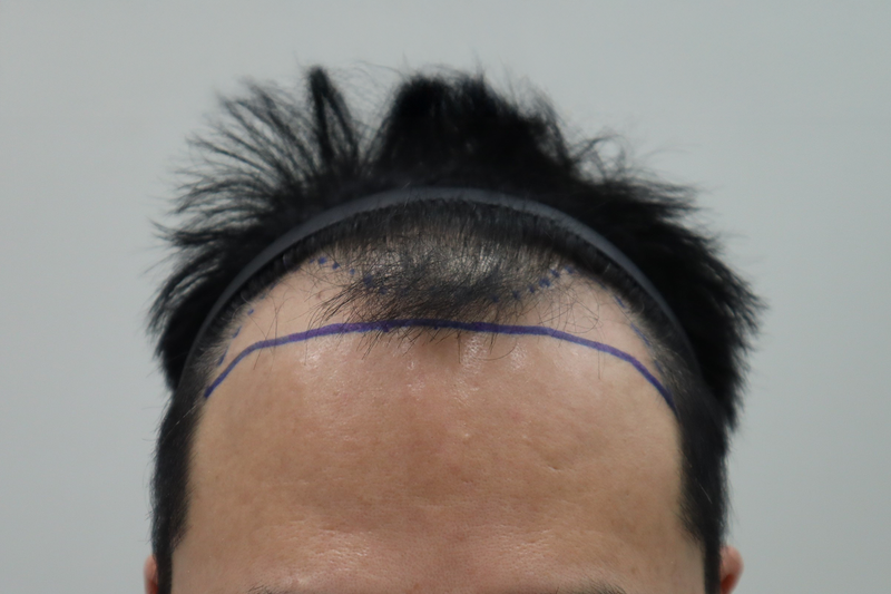 전주 헤어로의원에서 4000모 모발이식 비절개로 받고 2주 경과