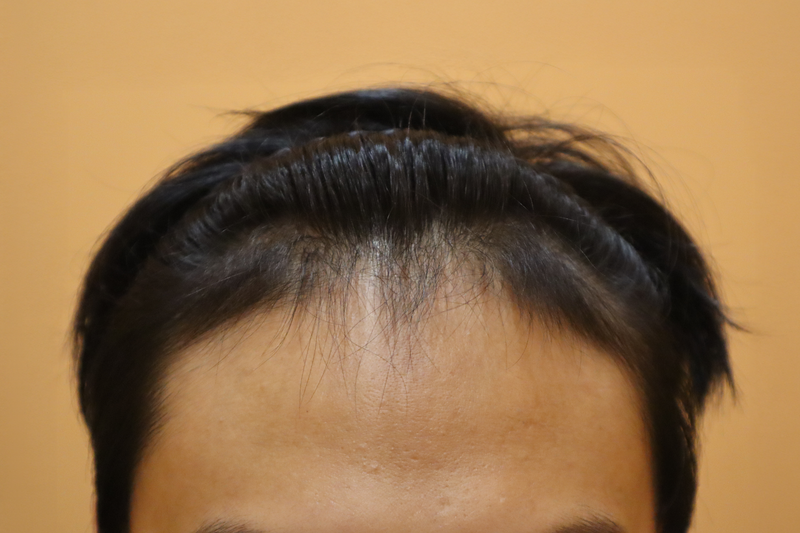 부산 헤어로의원 비절개 모발이식 3000모이식 솔직후기!