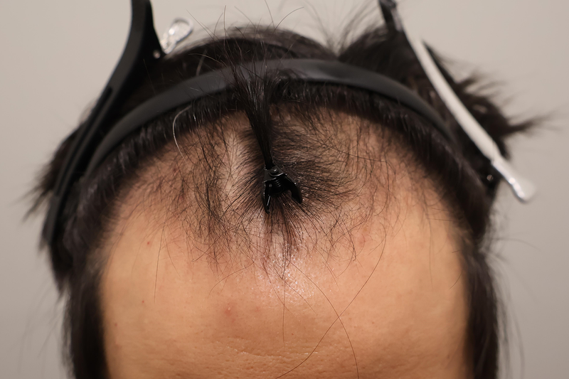 부산헤어로의원 1400모낭 세달경과 후기