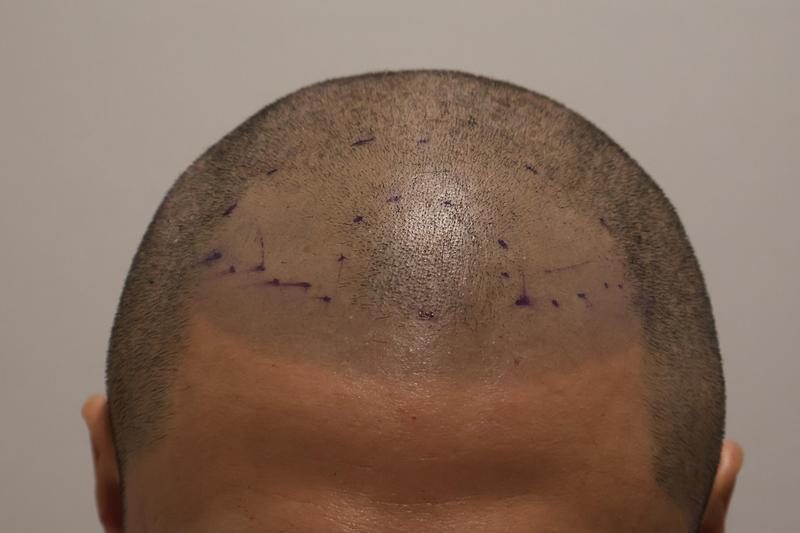 I got 1,200 hair follicles transplanted at Incheon Maimo Hospital