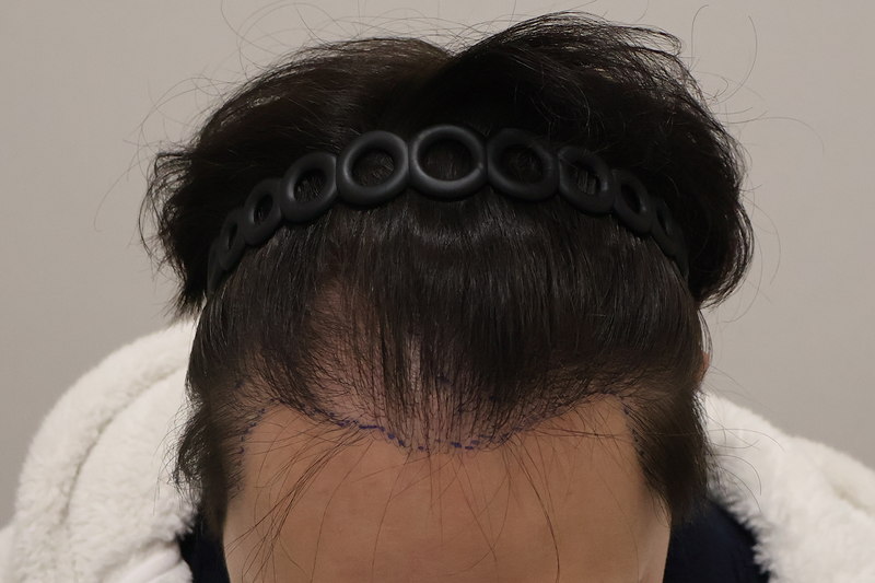 ドンタンヘアで医院 非切開 毛髪移植 2500毛 手術直後にレビューを書きます