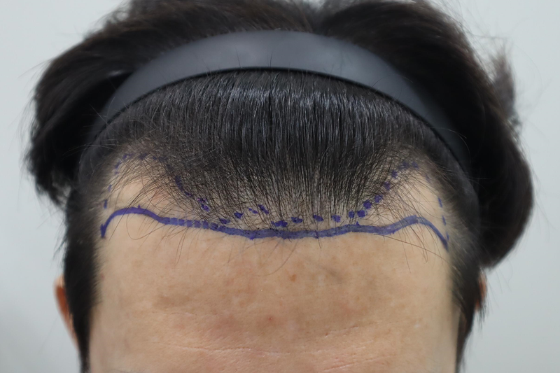 全州ヘアロ医院 雨切り 毛髪移植 1500本 2週間経過 レビュー