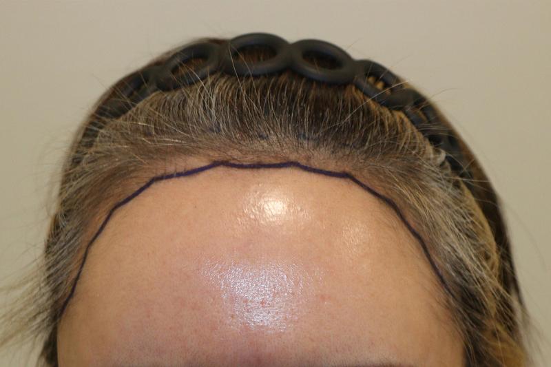 大邱ヘアロ医院2000本、9ヵ月経過最終後記