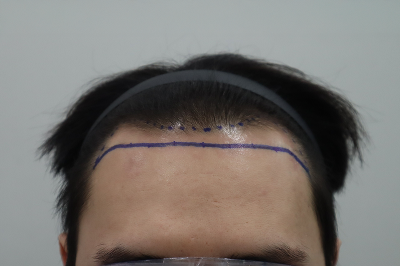 전주 헤어로 비절개 헤어라인 교정 2500모 2주 후기입니다