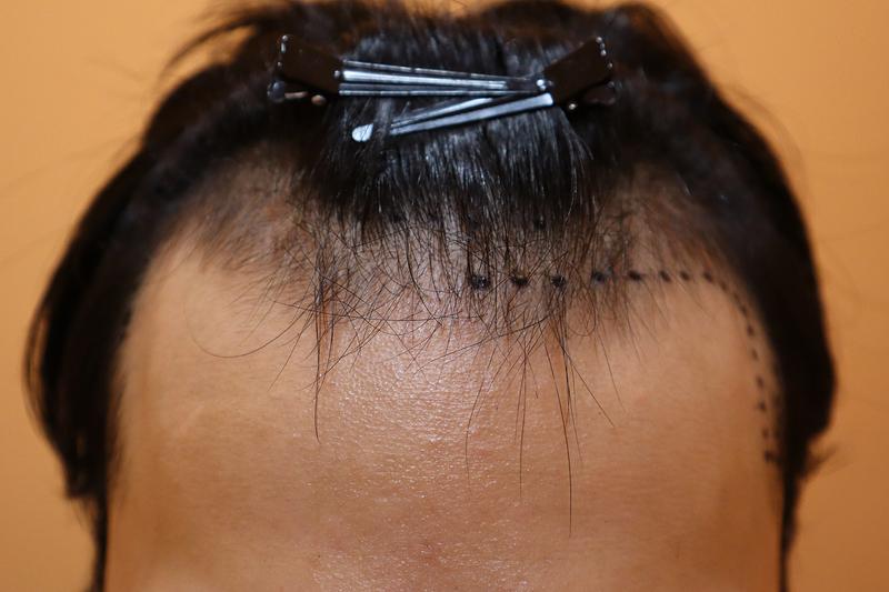 부산 헤어로 비절개 3600모 7개월 후기