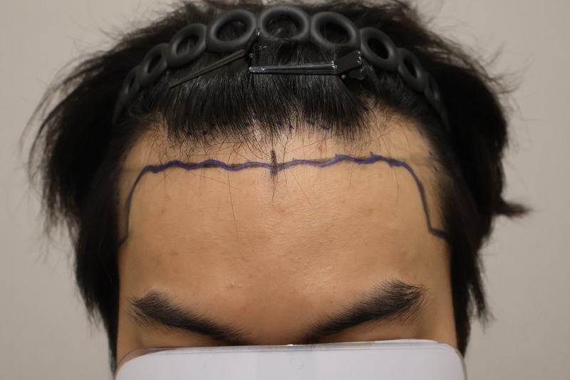 Dongtan Hairro Clinic Non-Cutting Hair Transplantation 2800 Hair Surgery Immediately After