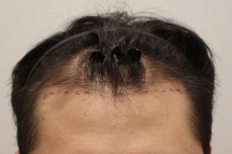 Busan Hairo Clinic's Non-Cutting 1400 Hair follicle transplant a month ago