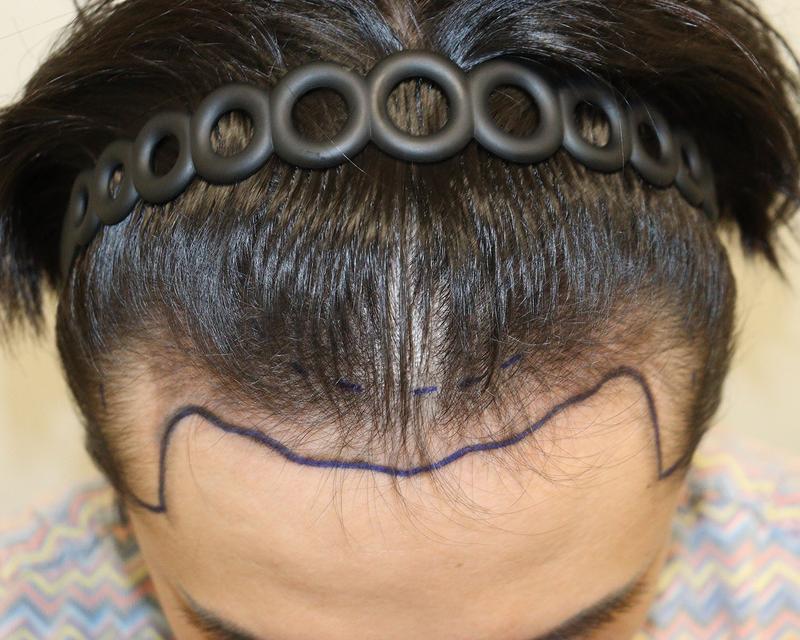Daegu Hair Clinic's 2800 hair incision two-week review of hair transplantation