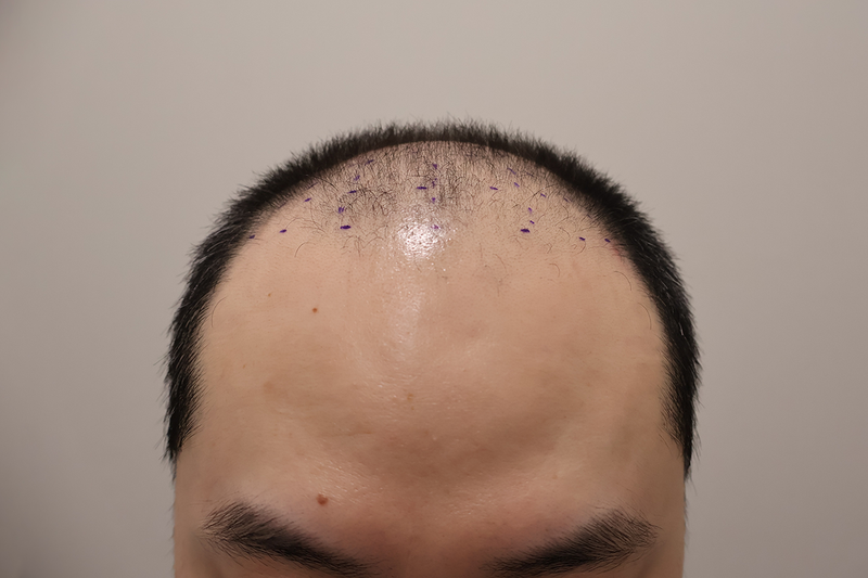 Incheon Maimo incision hair transplant 1300 hair follicle surgery