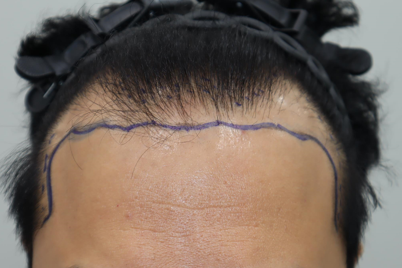 全州ヘアロ医院の非切開植毛後の体験談(9ヵ月経過)