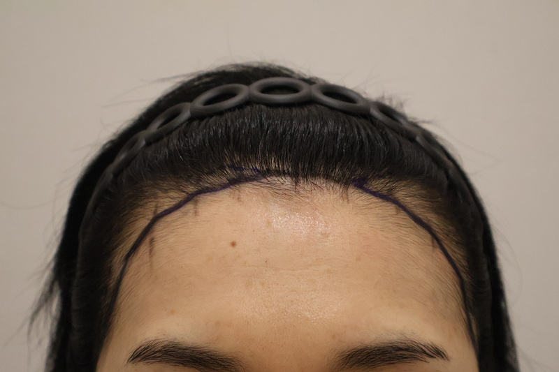 After 2,000 hairs for hairline correction received by incision with Dongtan hair, review