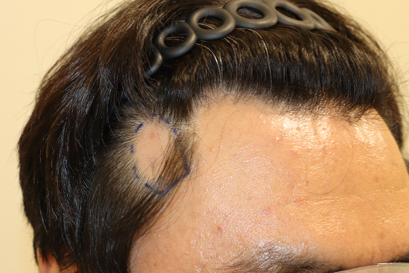 大邱ヘアロ医院 円形脱毛のような傷跡のための移植9ヶ月目のレビュー ありがとうございます