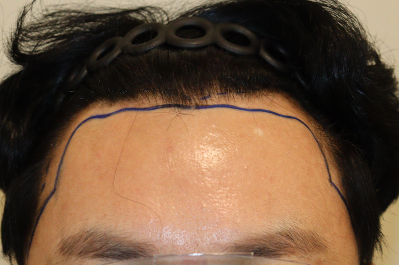 대구 헤어로의원 비절개 모발이식 2000모 1년 경과 후기