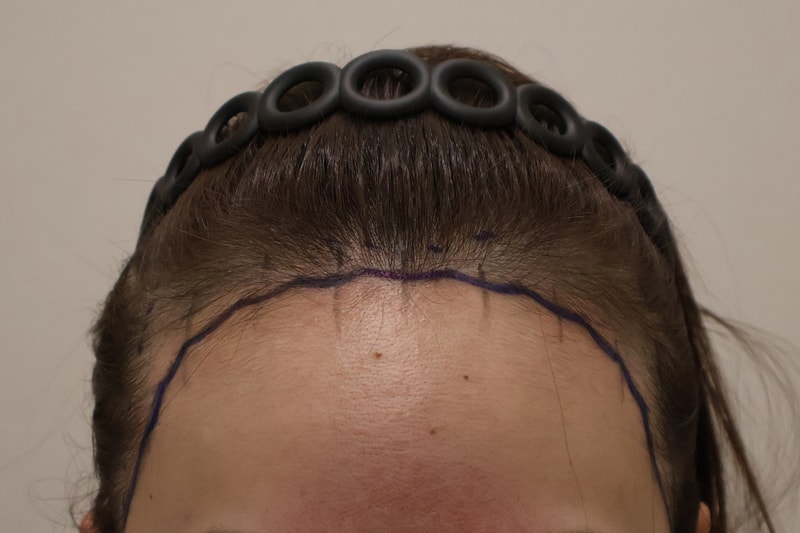 東灘ヘアで医院のヘアライン移植3400本を受けてきました