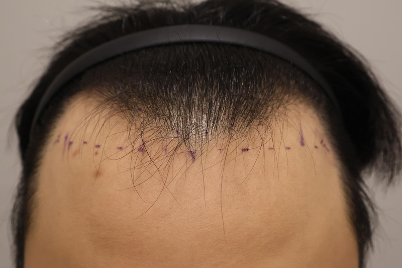 Incheon Maimo Clinic's non-cut hair transplant 1,500 hair follicles is a month's review