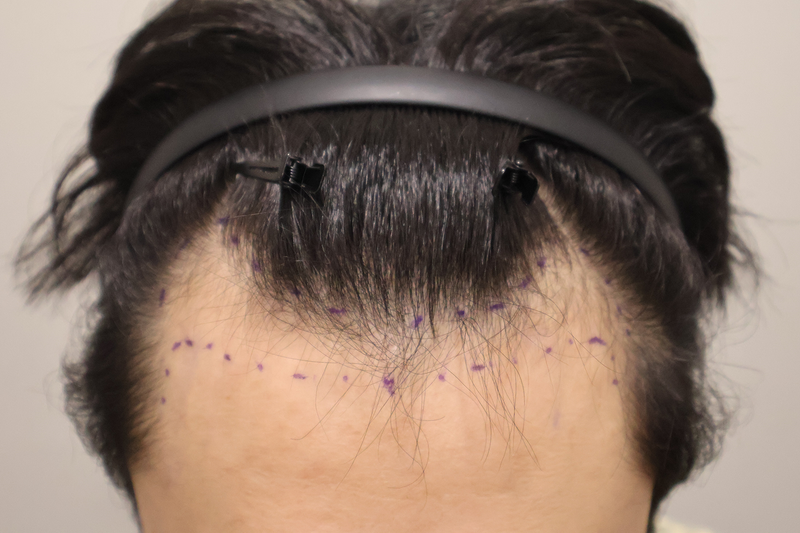 I had 1400 hair follicle surgery at Busan Hair Clinic