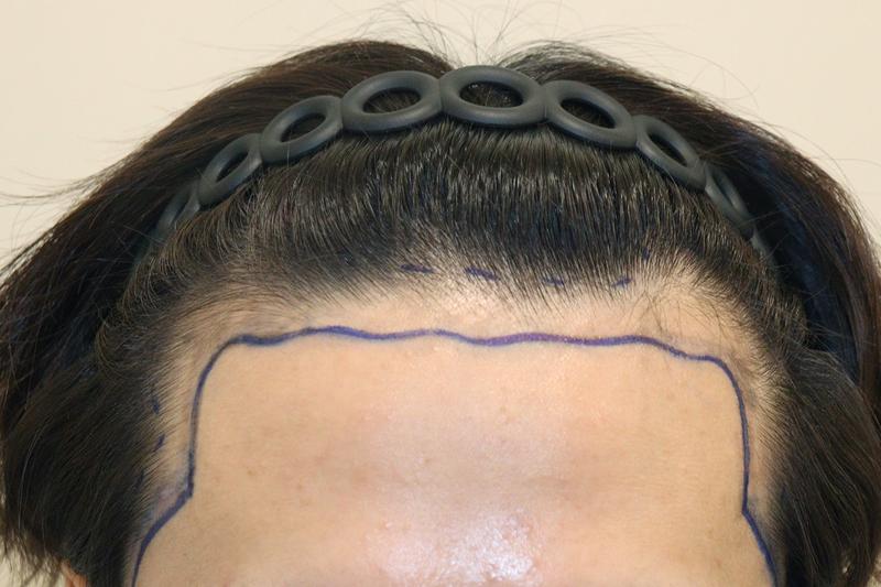 Daegu Hairo Clinic's non-intercept 2500 Mo 9 months later review