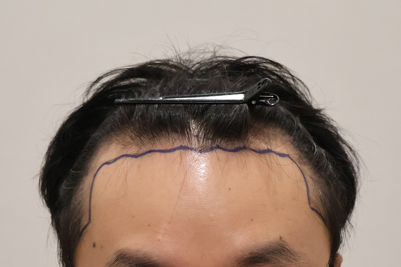 ドンタンヘアで医院 非切開 毛髪移植 3000本 手術直後のレビュー