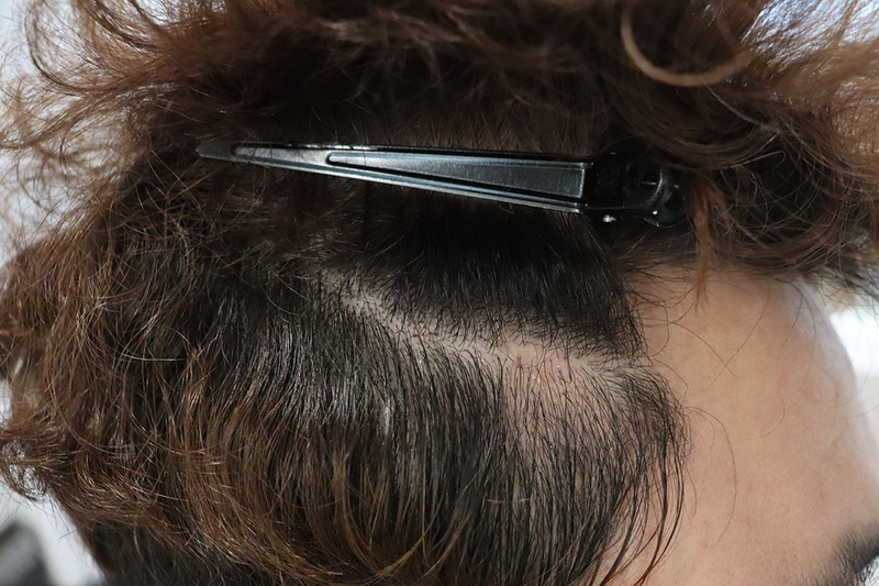 大邱ヘアで側面の傷跡毛髪移植1年最終レビュー