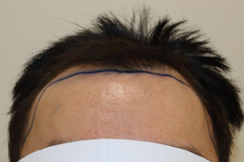 大邱HAIRO医院非切开2600毛发移植经过2周