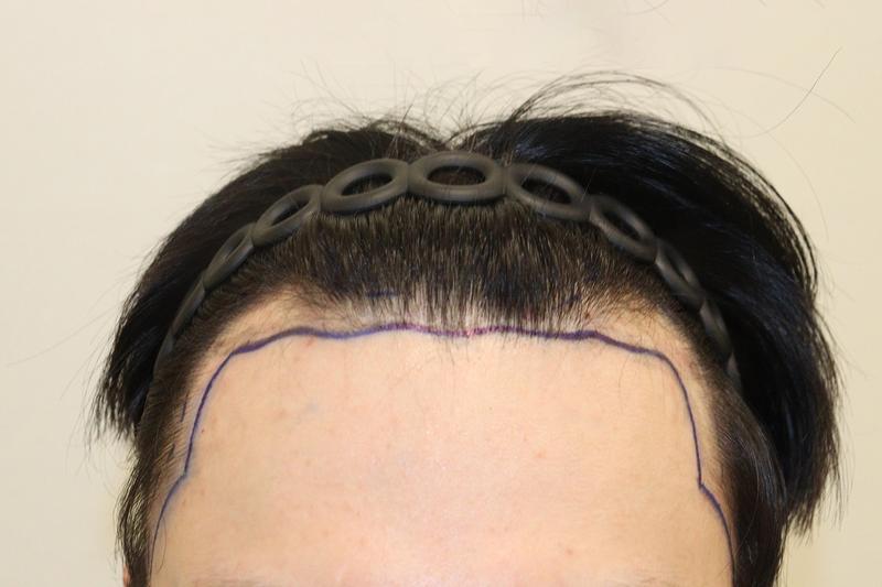 Daegu Hairrow Clinic's Non-Cutting No Cut 1600 Mo 9 Months Late
