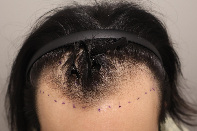 I received 1,500 hair follicle transplants for non-cut hair transplants at the Hairro Clinic in Busan.
